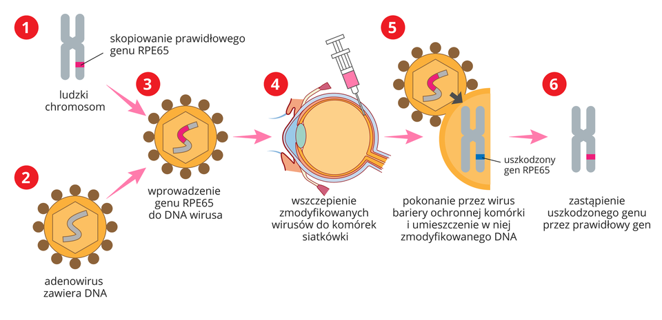 SSchemat ilustruje somatyczną terapię genową mającą na celu wyleczenie wrodzonej ślepoty. Na pierwszej ilustracji znajduje się chromosom ludzki w kształcie szarej litery X. Na jego prawym dolnym ramieniu widnieje niewielki, czerwony wycinek z podpisem: skopiowanie prawidłowego genu RPE65. Pod tą ilustracją znajduje się adenowirus zawierający DNA zobrazowany jako pomarańczowe koło, na obwodzie którego umieszczono niewielkie, brązowe kółka. Wewnątrz koła umieszczony jest jasnopomarańczowy sześciokąt, w którym znajduje się szeroka, szara linia w kształcie litery S. Od obu tych obrazków prowadzą strzałki do grafiki podpisanej jako: wprowadzenie genu RPE65 do DNA wirusa. Zilustrowany jest jako pomarańczowe koło, na obwodzie którego umieszczono niewielkie, brązowe kółka. Wewnątrz koła umieszczony jest jasnopomarańczowy sześciokąt, w którym znajduje się szeroka, szara linia w kształcie litery S. Fragment tej linii ma kolor czerwony. Od niego prowadzi strzałka do schematycznie przedstawionej gałki ocznej w postaci koła z soczewką w przedniej części, w którą wbita jest igła strzykawki wypełnionej czerwonym płynem. Pod spodem znajduje się podpis: wszczepienie zmodyfikowanych wirusów do komórek siatkówki. Kolejna strzałka prowadzi do ilustracji z wirusem zilustrowanym jako pomarańczowe koło, na obwodzie którego umieszczono niewielkie, brązowe kółka. Wewnątrz koła umieszczony jest jasnopomarańczowy sześciokąt, w którym znajduje się szeroka, szara linia w kształcie litery S. Fragment tej linii ma kolor czerwony. Wirus ten łączy się z komórką w kształcie półkola. Wewnątrz niej znajduje się chromosom ludzki w kształcie szarej litery X. Na jego prawym dolnym ramieniu znajduje się niewielki, niebieski wycinek z podpisem: uszkodzony gen RPE65. Następna strzałka prowadzi do ludzkiego chromosomu w kształcie szarej litery X. Na jego prawym dolnym ramieniu znajduje się niewielki, czerwony wycinek. Pod rysunkiem widnieje napis: zastąpienie uszkodzonego genu przez prawidłowy gen.