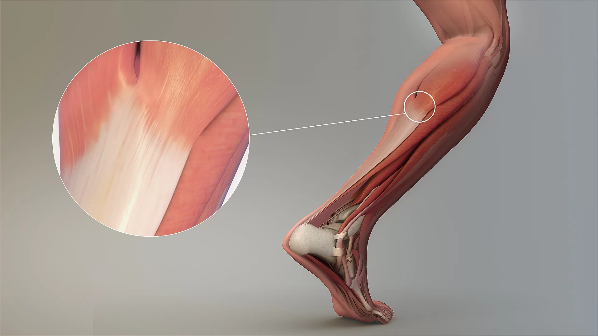 Ilustracja anatomiczna podudzia z zaznaczonymi mięśniami. Z tyłu podudzia, nieco pod kolanem, znajduje się ścięgno Achillesa. Jest szerokie i płaskie w części szczytowej, natomiast stopniowo zwęża się i grubieje ku dołowi - ku stopie.   