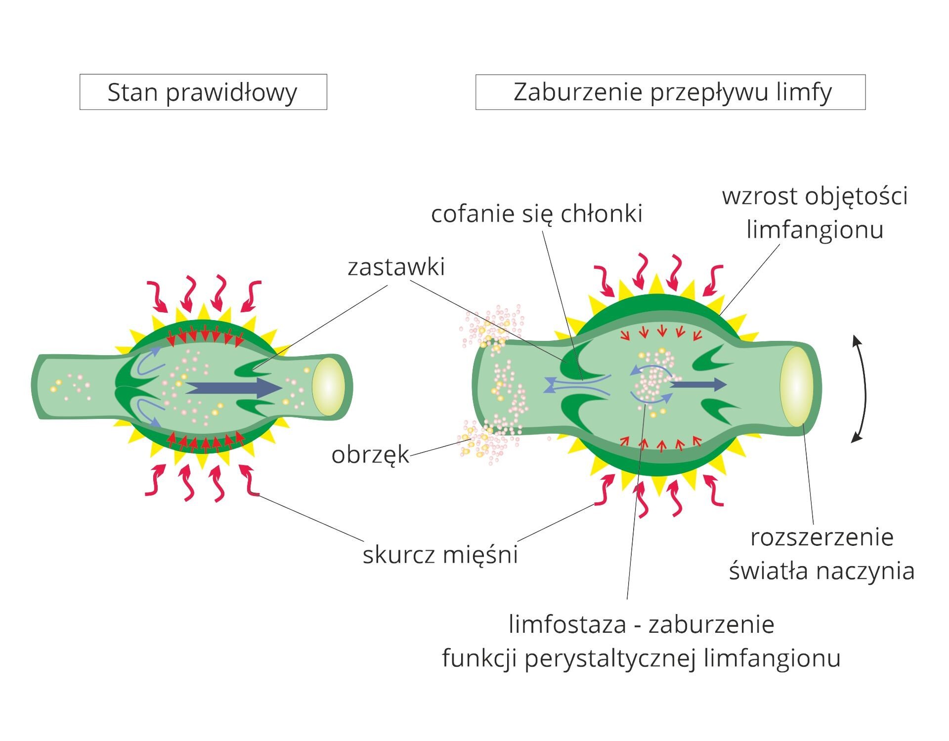 Grafika przedstawia schemat zatkania naczynia limfatycznego. W stanie prawidłowym skurcz mięśni w ścianach naczynia limfatycznego skutkuje zamknięciem zastawki i przepływem limfy w jednym kierunku. W zatkanym naczyniu skurcz ścian powoduje wzrost ciśnienia w naczyniu i cofanie się limfy poprzez niedomkniętą zastawkę, powodując zaburzenie jej przepływu. Powoduje to limfostazę, czyli zaburzeniem funkcji perystaltycznej limfangionu, skutkiem czego jest obrzęk.