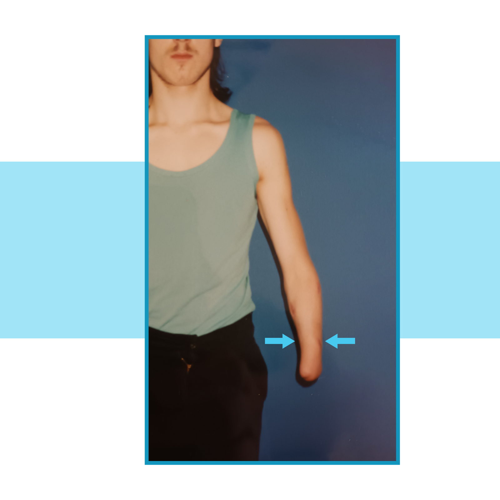 Zdjęcie pacjenta z długim kikutem przedramienia. Na rycinie znajdują się dwie strzałki wskazujące na centralną część przedramienia pacjenta.