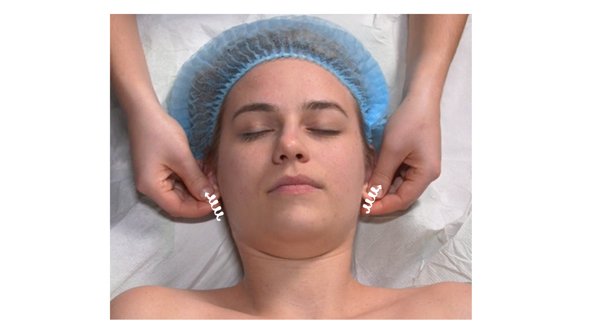 Zdjęcie przedstawia twarz pacjenta w leżeniu tyłem. Głowa pacjenta spoczywa na poduszce. Masażysta znajduje się za głową pacjenta i wykonuje ruch chwytem szczypcowym, kciukiem i palcem wskazującym obu rąk, kierując się od płatków uszu w stronę szczytu uszu.