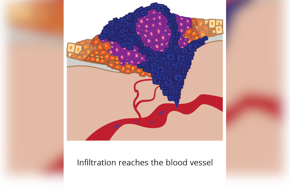 Ilustracja przedstawia guz rosnący wgłąb tkanki, do naczynia krwionośnego. Z krwią płyną komórki nowotworowe. Podpisano: Infiltration reaches the blood vessel