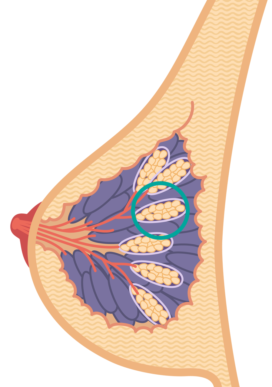 Ilustracja przedstawia gruczoły mlekowe w kobiecej piersi. To owalne struktury zbudowane ze skupiska owalnych kuleczek - pęcherzyków. Umiejscowione są w pobliżu brodawki. Dochodzą do nich przewody mleczne biegnące od brodawki sutka.  
