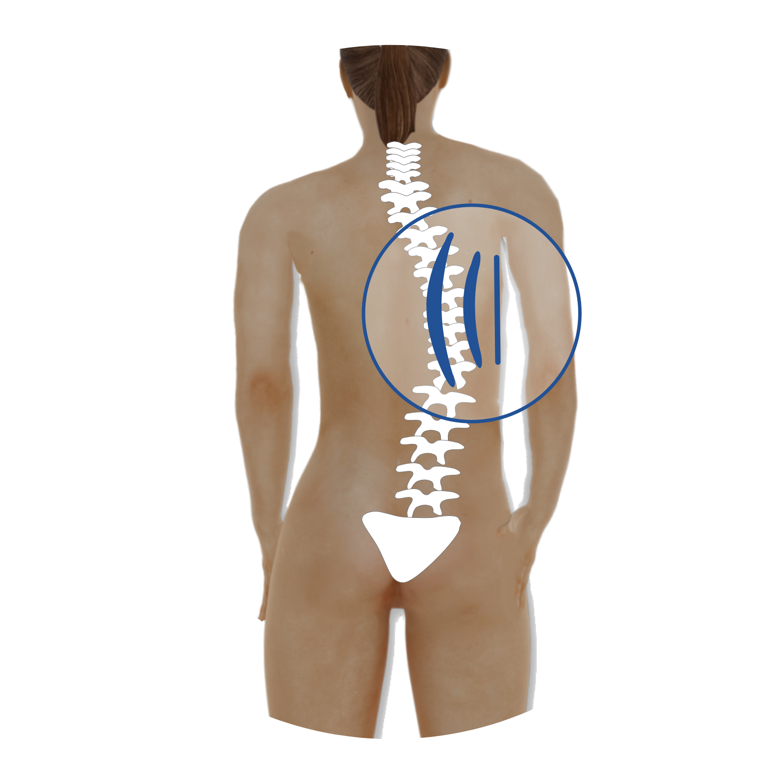 Grafika przedstawiająca umiejscowienie peloty w odcinku piersiowym kręgosłupa.