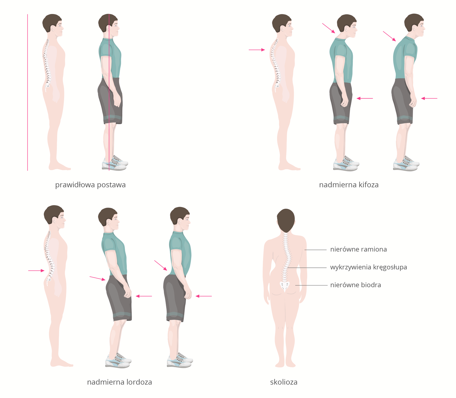 Ilustracja przedstawia cztery postawy: jedną prawidłową i trzy nieprawidłowe. Sylwetki człowieka w kolorze różowym mają wrysowany biały kręgosłup z krzywiznami. Sylwetki ubrane w niebieską koszulkę i czarne spodenki mają strzałkami zaznaczone nieprawidłowości. W górnym rzędzie z lewej sylwetka prawidłowa. Czerwona pionowa kreska wyznacza oś ciała. Z prawej nadmierna kifoza, czyli uwypuklenie części piersiowej kręgosłupa do tyłu. U dołu z lewej nadmierna lordoza, czyli uwypuklenie części lędźwiowej kręgosłupa do przodu. Z prawej jedna sylwetka widziana od tyłu, z bocznym skrzywieniem kręgosłupa, czyli skoliozą. Wskazano nierówne ramiona, wykrzywienie kręgosłupa i nierówne biodra.