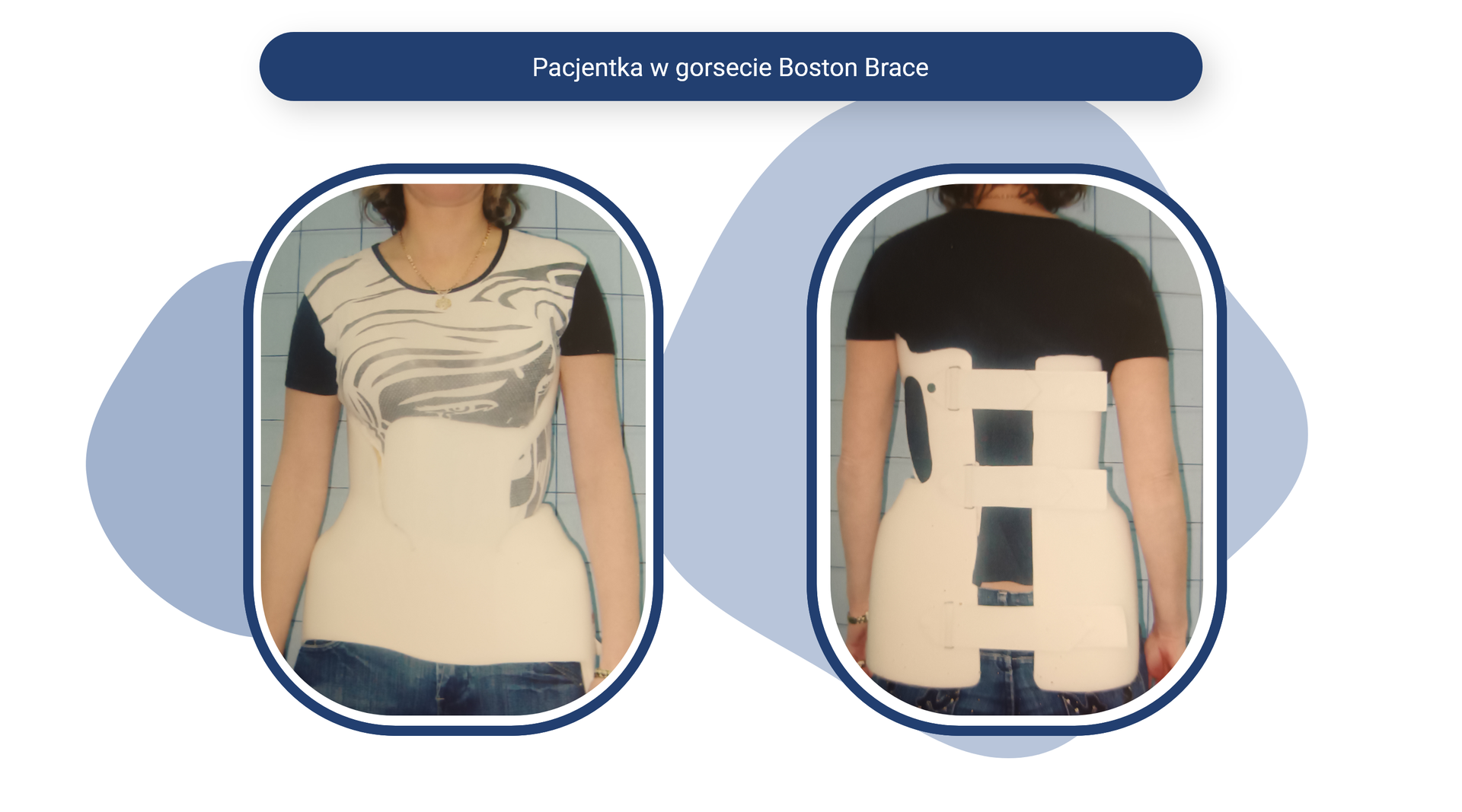 Plansza pod tytułem: Pacjentka w gorsecie Boston Brace. Plansza zawiera dwa zdjęcia.
Pierwszym jest zdjęcie pacjentki w widoku z przodu. Widnieje na nim pacjentka w sięgającym do klatki piersiowej gorsecie z profilowanym odcinkiem biodrowym.
Drugie to zdjęcie pacjentki w widoku z tyłu. Widnieje na nim pacjentka w sięgającym do łopatek gorsecie z profilowanym odcinkiem biodrowym. Gorset mocowany jest na trzech rzepach: w miejscu kości lędźwiowych, talii i na wysokości łopatek.
