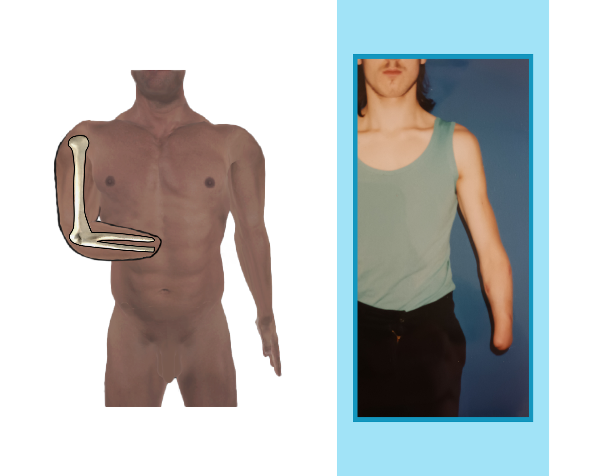 Grafika i zdjęcie przedstawiające pacjenta z długim kikutem przedramienia. 
