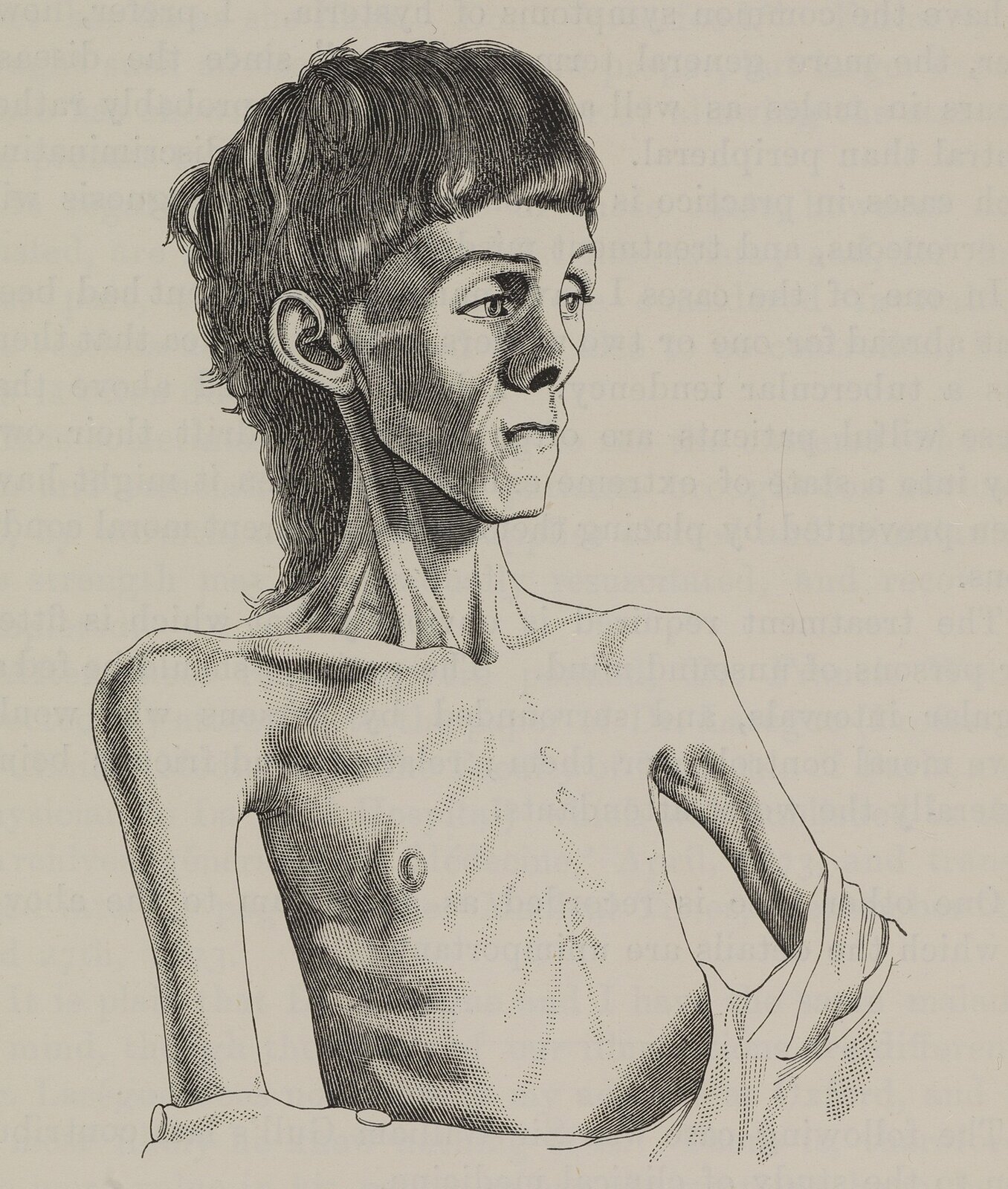 Grafika przedstawia osobę z jadłowstrętem psychicznym. Ma ona wychudzoną twarz z zapadniętymi policzkami.