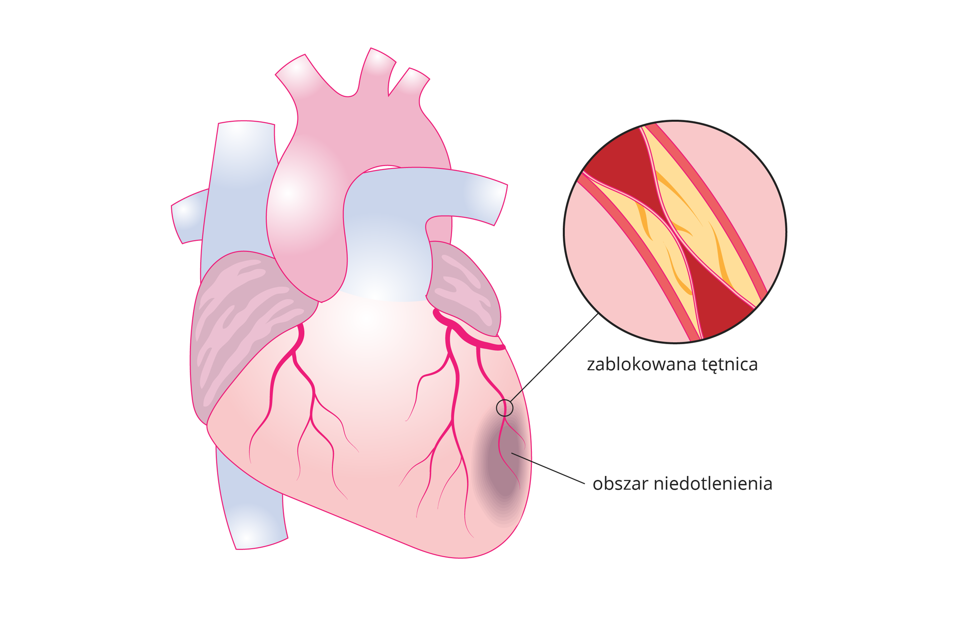 Ilustracja przedstawia schematyczny rysunek serca wraz z obrazem fragmentu tętnicy w zbliżeniu. Powierzchnia serca jest różowa, a tętnice oraz żyły łączące się z sercem są błękitne. W górnej części serca mieści się aorta. Powierzchnię serca tworzą czerwone naczynia krwionośne, które rozgałęziają się ku dołowi. Zaznaczony na obrazie fragment tętnicy w zbliżeniu znajduje się po prawej stronie w kole z czarną obwódką. Pokazano na nim, że tętnica jest zablokowana złogami cholesterolu do poziomu uniemożliwiającego swobodny przepływ krwi. Poniżej zwężonej tętnicy zaznaczono ciemną owalną plamą obszar niedotlenienia mięśnia sercowego.