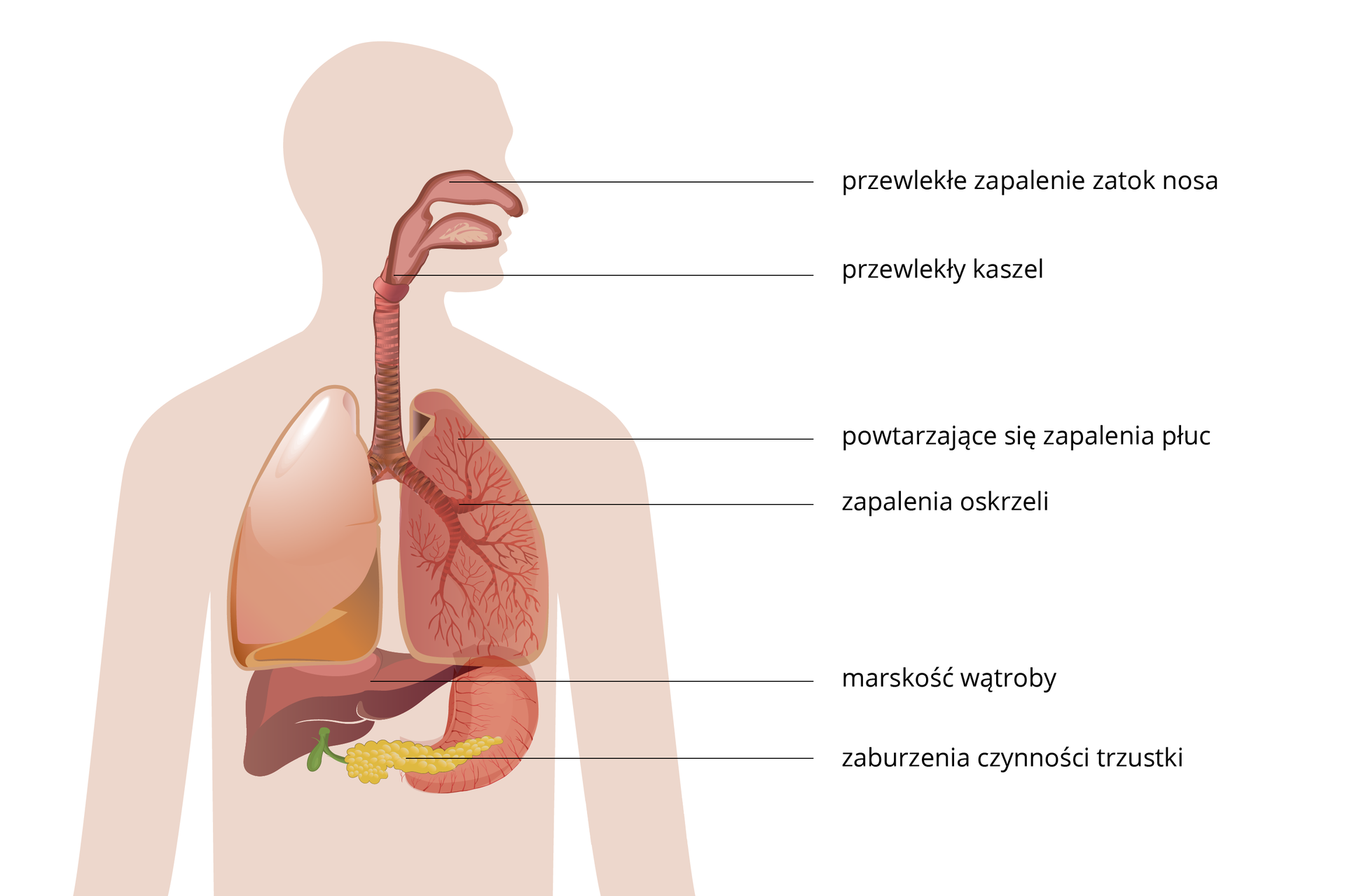 Ilustracja przedstawia sylwetkę człowieka z wrysowanym układem oddechowym, wątrobą, trzustką i żołądkiem. Opisy z boku wskazują miejsce występowania objawów. Objawy mukowiscydozy to: przewlekłe zapalenie zatok nosa, przewlekły kaszel, powtarzające się zapalenia płuc, zapalenia oskrzeli, marskość wątroby, zaburzenia czynności trzustki.