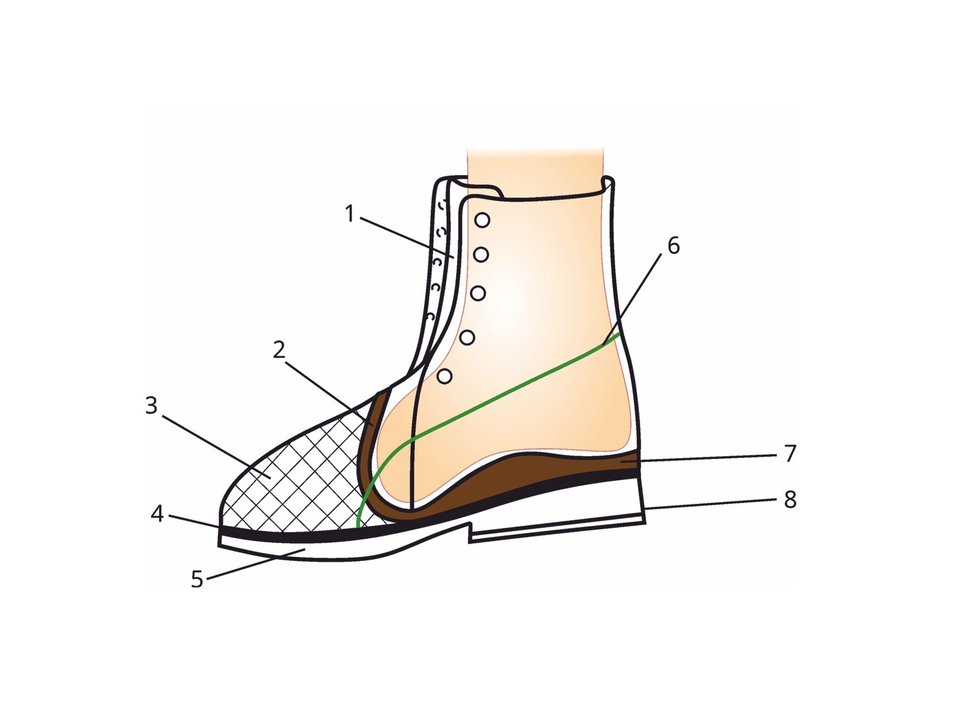 Grafika przedstawia schemat budowy buta, stosowanego przy ubytku części stopy, z wysoką cholewką i sznurowaniem normalnym. Na grafice zostały oznaczone elementy takie jak język usztywniony, miękkie wyścielenie, uzupełnienie ubytku stopy, usztywniacz przedstopia między podpodeszwą a podeszwą, podeszwa kołyskowa, zakładka, podparcie sklepienia podłużnego i obcas.