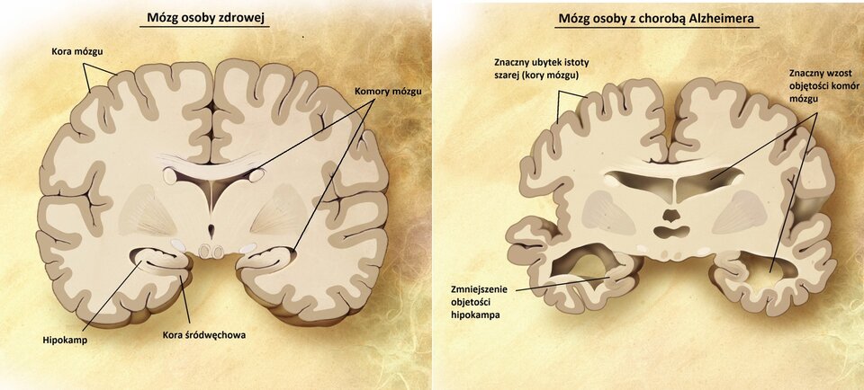 Na ilustracji obok siebie jest przekrój przez mózg osoby zdrowej i osoby z chorobą Alzheimera. Górna powierzchnia mózgu to kora mózgu. Jest pofałdowana. Na przekroju zaznaczono komory mózgu - to wolne przestrzenie w centralnej i przedniej części zwanej hipokampem. W pobliżu hipokampa jest kora śródwęchowa. U osoby chorej można zauważyć znaczny ubytek istoty szarej (kory mózgu), znaczny wzrost objętości komór mózgu oraz zmniejszenie objętości hipokampa.        