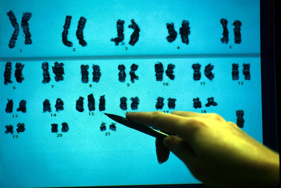 Na zdjęciu zobrazowany jest przegląd wyników badań chromosomów. Na niebieskiej tablicy widoczne jest 21 par chromosomów w postaci równoległych, nieregularnych linii zbliżonych kształtem do litery X. Pod numerem 15 widać trzy równoległe do siebie linie. W dolnym rogu znajduje się ludzka dłoń ze czarnym, cienkim, zaostrzonym na końcu wskaźnikiem, który dotyka tablicy. 