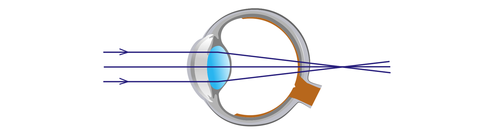 Na ilustracji zostało schematycznie pokazane oko jako kula. Przed okiem widzimy równoległe do siebie promienie światła w postaci odcinków. W momencie przejścia przez soczewkę oka ulegają one załamaniu i przecinają się w jednym punkcie znajdującym się za siatkówką oka. Wadę w której promienie przecinają się za siatkówką nazywamy dalekowzrocznością.