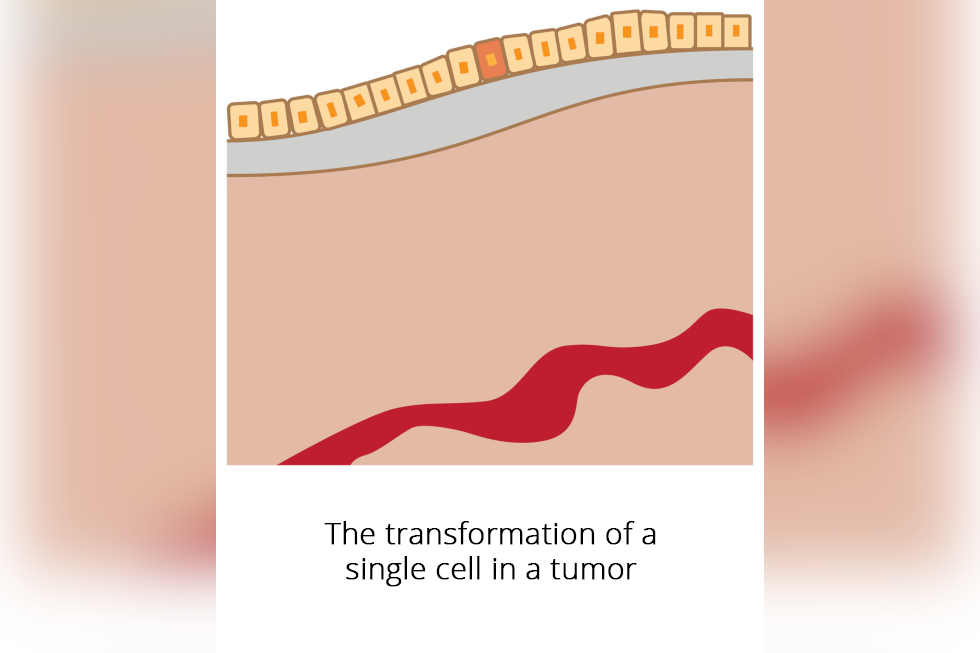 Schemat przedstawia pojedynczą komórkę, w której zaszła zmiana nowotworowa. Podpisano: The transformation of a single cell in a tumor