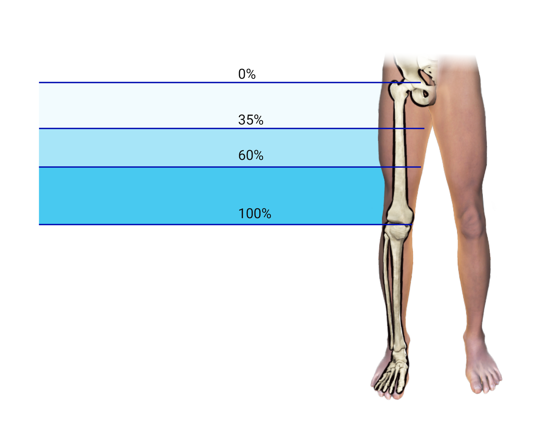 Grafika przedstawia schemat kończyn dolnych człowieka. Na rycinie zaznaczono elementy szkieletu oraz wartości procentowe kikutów uda na całej długości kości udowej.
