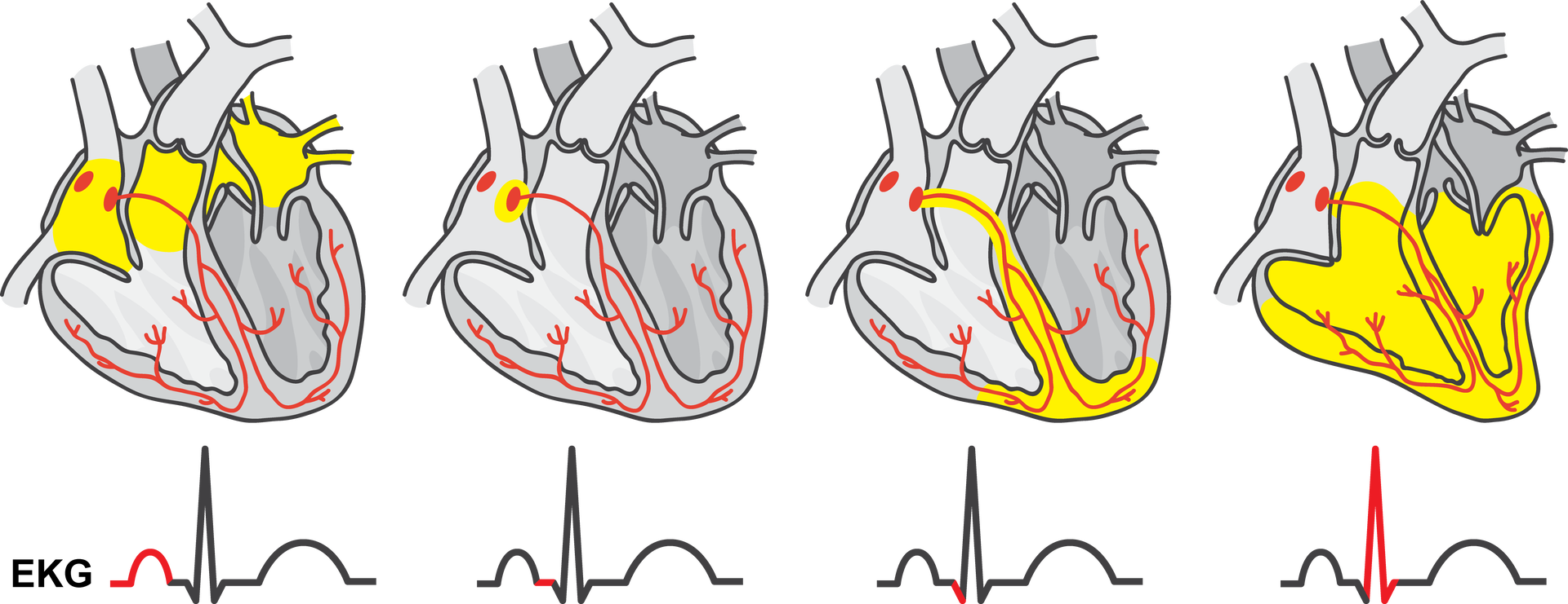 Ilustracja przedstawia schemat zjawisk elektrycznych w pracy serca odpowiadających fragmentom pracy EKG. Na ilustracji są cztery serca z miejscami zaznaczonymi kolorem żółtym. W pierwszym sercu zaznaczony jest obszar w jego górnej części (na krzywej EKG zaznaczono na czerwono niewielkie wybrzuszenie). Na drugiej ilustracji tylko niewielkie miejsce zaznaczone w górnej prawej części serca ((na krzywej EKG zaznaczono poziomą linię prostą). Na kolejnym zdjęciu na żółto zaznaczono obszar pomiędzy komorami serca (na krzywej EKG zaznaczono na czerwono niewielki spadek), na ostatnim znaczną część serca (na krzywej zaznaczono gwałtowny wzrost i spadek, maksymalne odchylenie w górę).