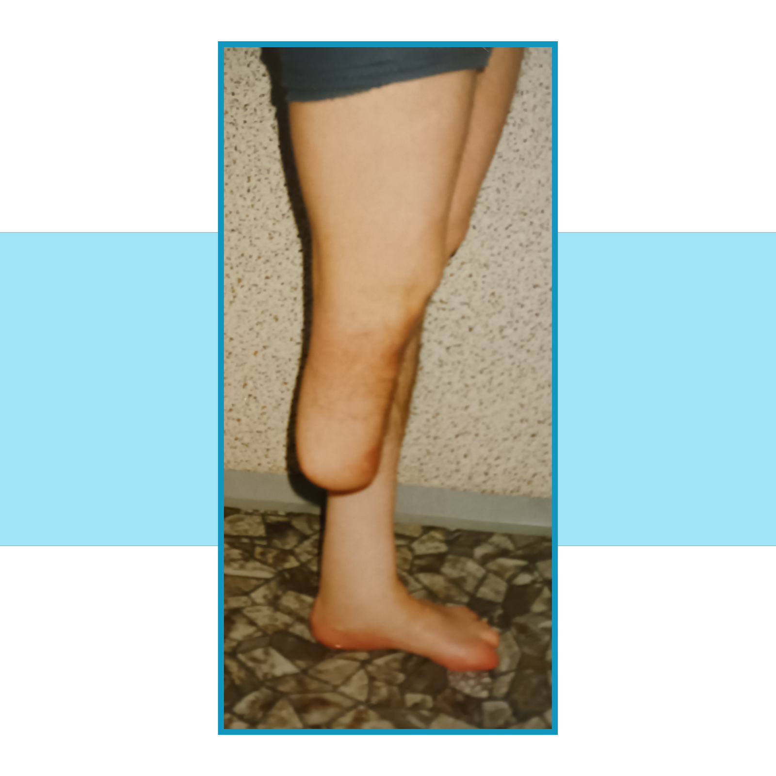 Zdjęcie średniej długości kikuta kończyny dolnej po amputacji w rejonie podudzia.