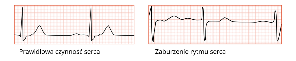 Ilustracja przedstawia dwa odczyty czynności serca. Z lewej strony znajduje się prawidłowy odczyt rytmu serca, jest on okresowy, czyli powtarza się co jakiś okres. Po prawej stronie znajduje się odczyt zaburzonego rytmu serca, jest on nieregularny.