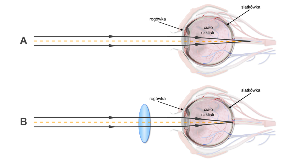 Ilustracja przedstawia dwie gałki oczne, na których pokazano nadwzroczności. Zaznaczono przednią część oka - rogówkę, ciało szkliste - substancję wypełniającą tylną część gałki ocznej, oraz siatkówkę. W oku nadwzrocznym równoległe promienie świetne ogniskowane są za siatkówką. Po korekcji przez soczewkę skupiającą, wypukłą, okularów skupiają się prawidłowo - na siatkówce. 