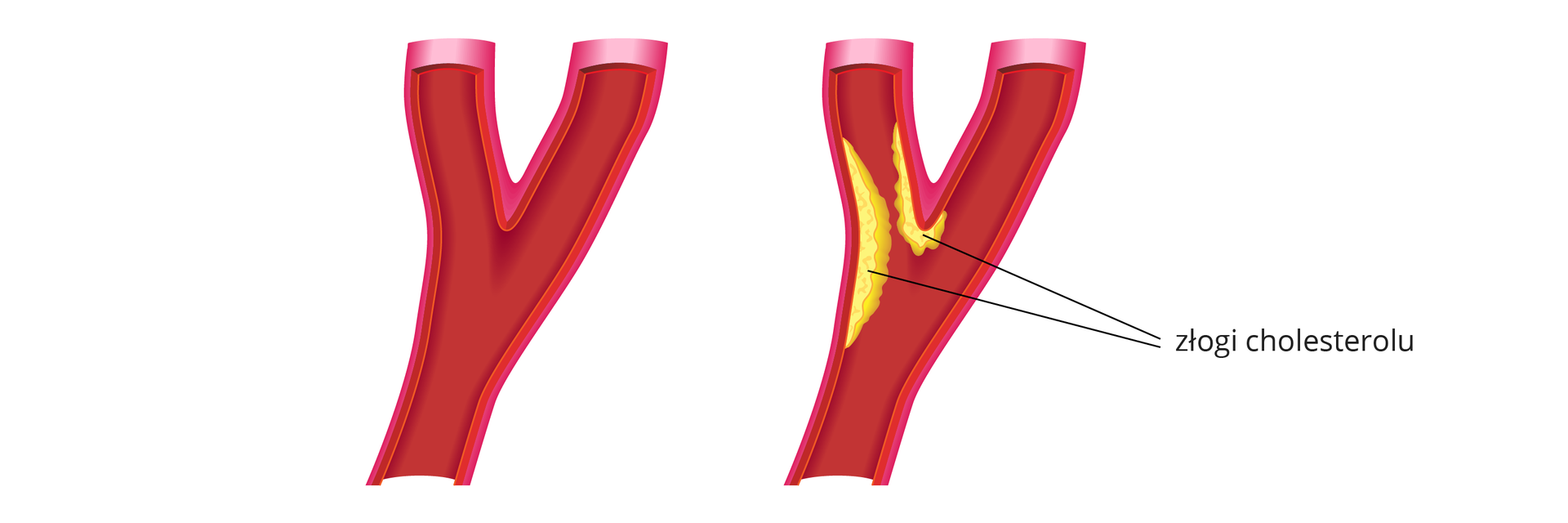 Ilustracja przedstawia schematyczny obraz dwóch tętnic wieńcowych. Tętnice u dołu są pojedyncze i rozwidlają się w połowie wysokości na dwie odnogi. Lewa tętnica to przykład zdrowego naczynia. Z kolei prawa jest zwężona w lewej odnodze. Na ściankach tętnicy dostrzegalne są żółte złogi cholesterolu, które zwężają kanał przepływu krwi.