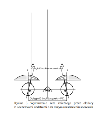 Grafika przedstawia wymuszenie zeza zbieżnego przez okulary z soczewkami ujemnymi o za dużym rozstawieniu soczewek.
