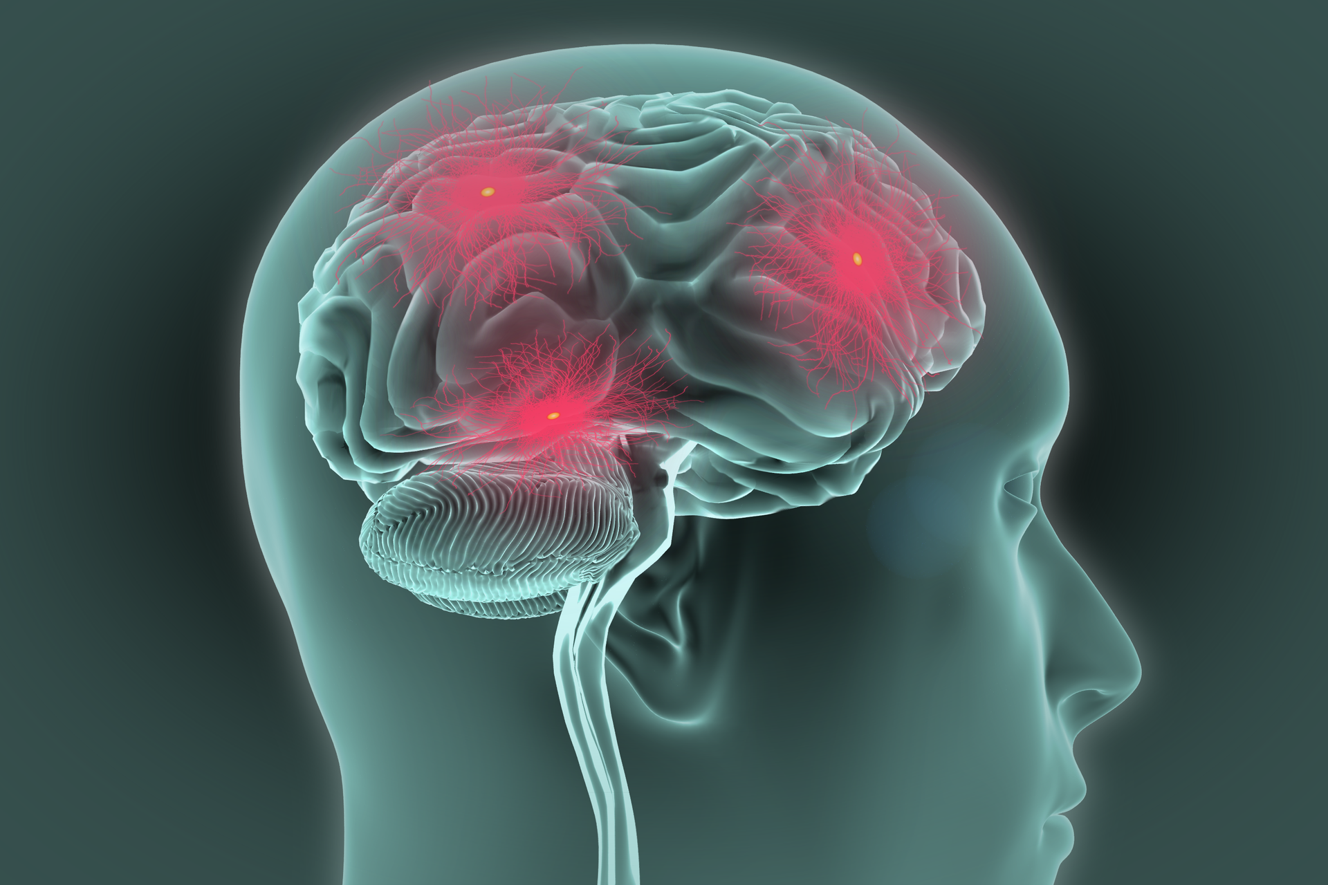 Grafika komputerowa przedstawia ludzką głowę z profilu i naniesiony na nią obraz mózgu. Twarz postaci jest skierowana w prawo. Na powierzchni mózgu można zauważyć liczne pofałdowania, znacznie liczniejsze i drobniejsze w tylnej dolnej części, czyli tak zwanym móżdżku. Na powierzchni mózgu znajdują się trzy czerwone punkty wskazujące miejsca wyładowań elektrycznych w komórkach nerwowych. Miejsca te przypominają wierzchołki trójkąta. Punkt po prawej znajduje się w płacie czołowym. Punkt drugi mieści się nad uchem. Trzeci punkt usytuowano w górnej części mózgu.