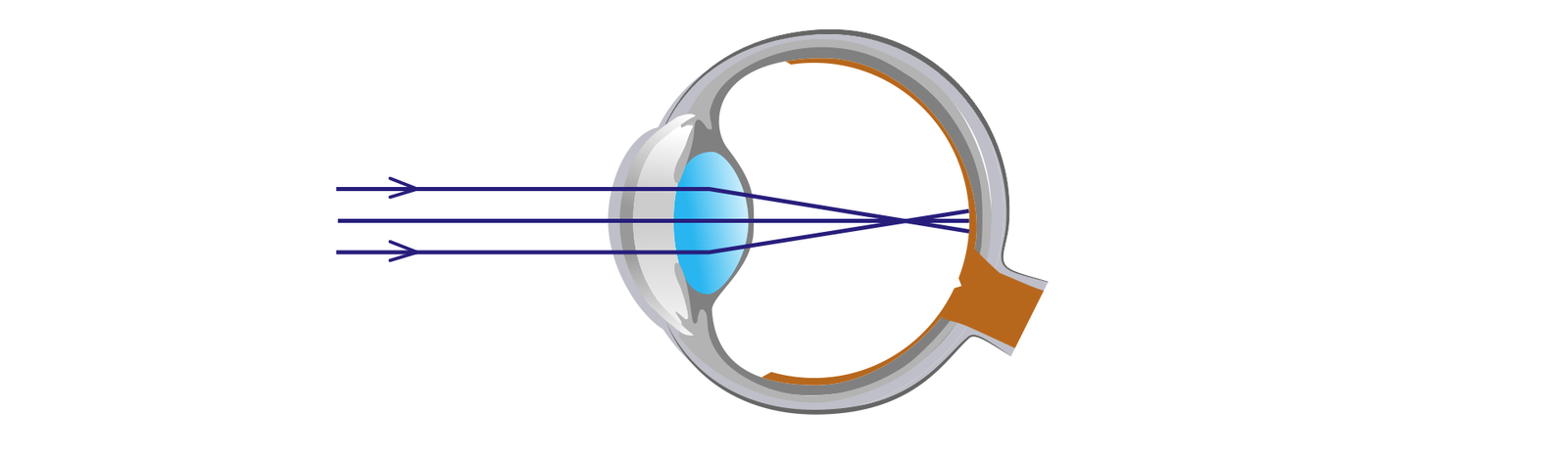 Na ilustracji zostało schematycznie pokazane oko jako kula. Przed okiem widzimy równoległe do siebie promienie światła w postaci odcinków. W momencie przejścia przez soczewkę oka ulegają one załamaniu i przecinają się w jednym punkcie znajdującym się przed siatkówką oka. Wadę w której promienie przecinają się przed siatkówką nazywamy krótkowzrocznością.