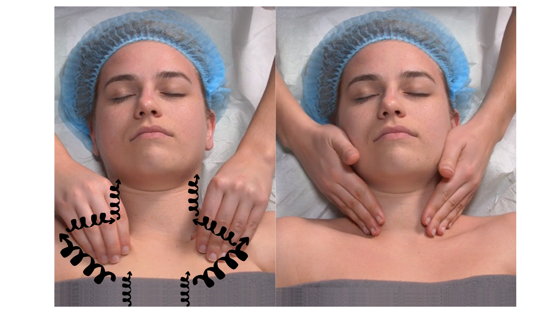 Zdjęcie przedstawia twarz pacjenta w leżeniu tyłem. Głowa pacjenta spoczywa na poduszce. Masażysta znajduje się za głową pacjenta i opuszkami palców obu rąk wykonuje ruch rozcierania od rękojeści mostka, przez linię obojczyków, boczną stronę szyi aż do linii brody. 