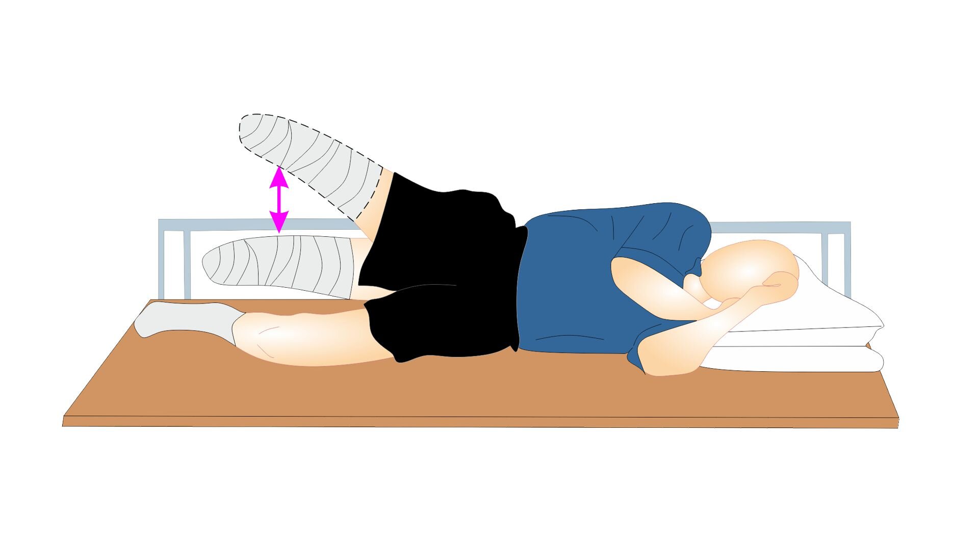 Grafika przedstawia pacjenta w ułożeniu bokiem na lewej stronie. Prawa noga pacjenta amputowana jest na poziomie podudzia. Ręce i poduszka znajdują się pod głową. Pacjent unosi amputowaną kończynę.