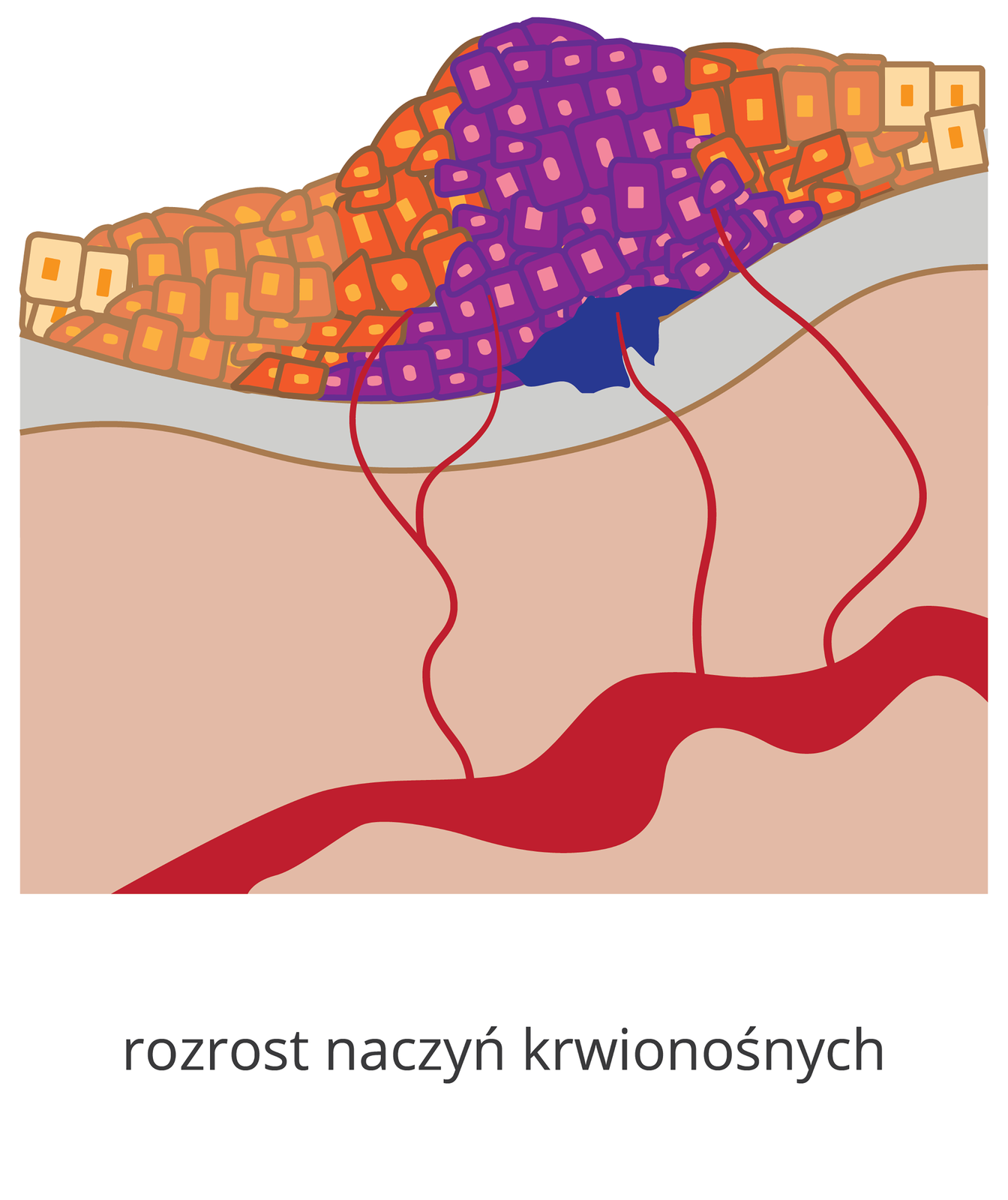 Ilustracja przedstawia guz z naczyniami włosowatymi. Widoczne są liczne komórki nowotworowe tworzące kilka warstw. Mają one trzy kolory, blado brązowy kolor oznacza najstarsze komórki nowotworowe, pomarańczowy młodsze, a fioletowy najmłodsze i najbardziej niezróżnicowane. Guz zaczyna naciekać na tkanki znajdujące się poniżej. Naciek zaznaczony jest niebieskim kolorem. Warstwa, na którą nacieka nowotwór i warstwa poniżej są narysowane schematycznie, nie widać poszczególnych komórek. W głębi drugiej warstwy widać czerwone naczynie krwionośne. Od guza do naczynia krwionośnego prowadzą małe naczynia włosowate, które doprowadzają krew do guza. Pod obrazkiem widać napis: rozrost naczyń krwionośnych.