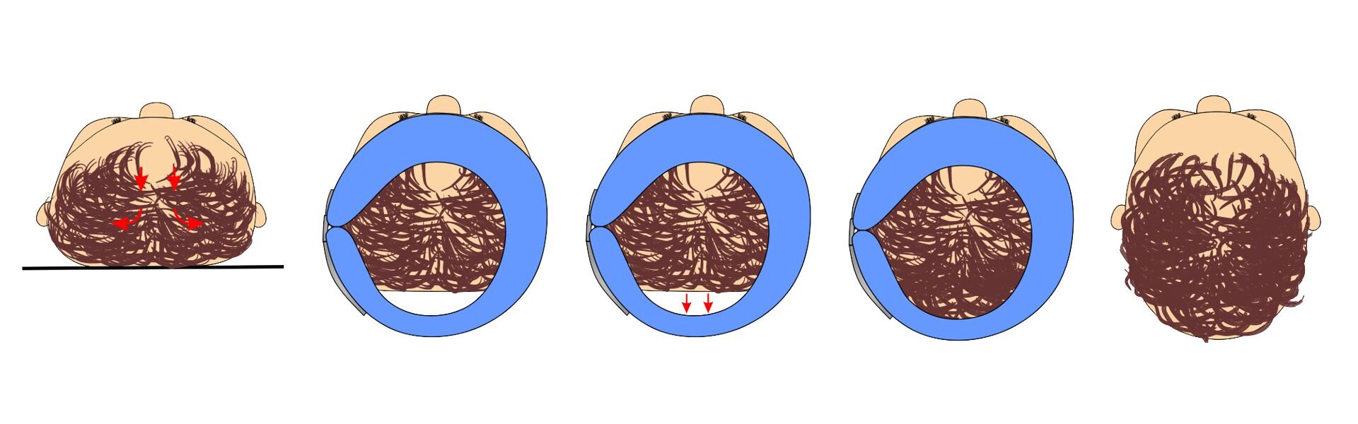 Grafika przedstawia schemat przebiegu zmian kształtowania głowy za pomocą kasku korekcyjnego. Schemat przedstawiono za pomocą pięciu grafik prezentujących, w widoku z góry, ludzką głowę ze spłaszczonym wybrzuszeniem tyłu czaszki i głowę bez tego zniekształcenia. 
Pierwsza grafika przedstawia ludzką głowę ze spłaszczonym wybrzuszeniem tyłu czaszki. 
Druga grafika przedstawia ludzką głowę ze spłaszczonym wybrzuszeniem tyłu czaszki. Pacjent, którego głowa jest zniekształcona, ma włożony kask korekcyjny. 
Trzecia grafika przedstawia ludzką głowę ze spłaszczonym wybrzuszeniem tyłu czaszki. Pacjent ma włożony kask korekcyjny. Na grafice znajdują się strzałki ukazujące wydłużenie tyłu czaszki.
Czwarta grafika przedstawia głowę człowieka, u którego skorygowano spłaszczone wybrzuszenie tyłu czaszki. Pacjent ma włożony kask korekcyjny. Głowa pacjenta nie ma śladu zniekształcenia.
Piąta grafika przedstawia głowę człowieka, którego czaszka ma prawidłowy kształt.
