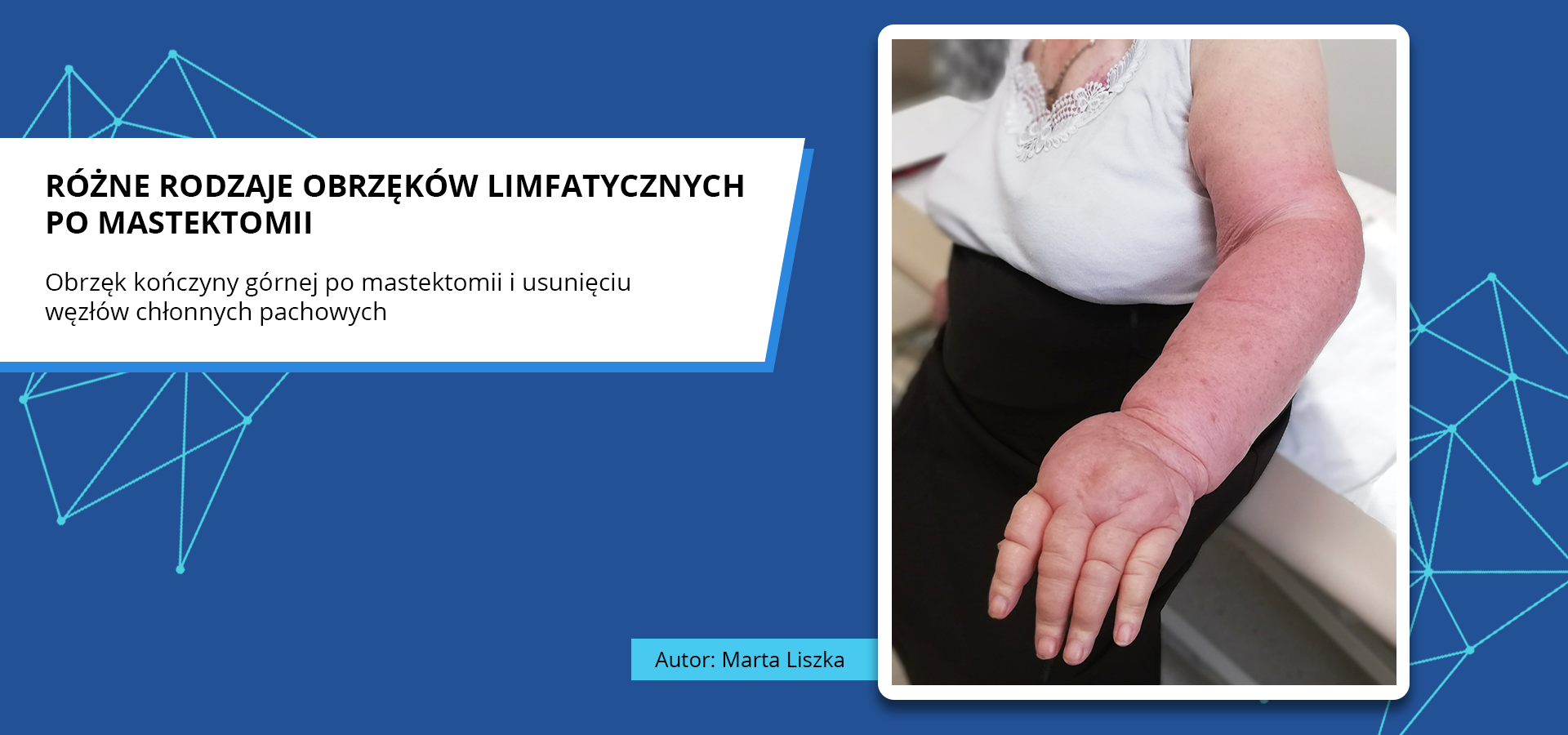 Zdjęcie o tytule różne rodzaje obrzęków limfatycznych po mastektomii. Obrzęk kończyny górnej po mastektomii i usunięciu węzłów chłonnych pachowych. Zdjęcie przedstawia wyprostowaną kończynę górną pacjentki siedzącej na kozetce lekarskiej. Kończyna górna jest wyraźnie opuchnięta i zaczerwieniona. Autorka zdjęcia: Marta Liszka.