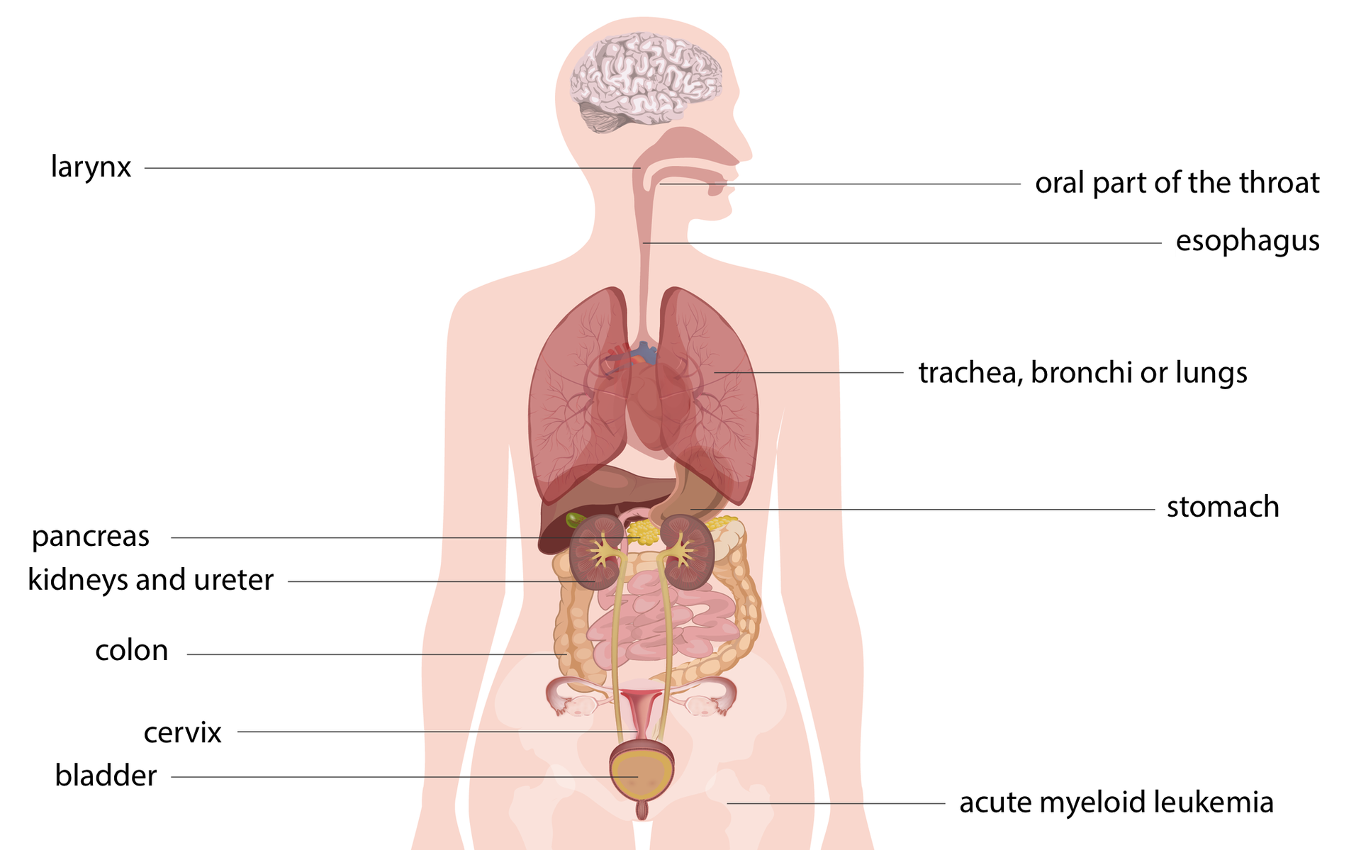 Ilustracja przedstawia sylwetkę człowieka z wrysowanymi narządami: z lewej: larynx, pancreas, kidneys and ureter, colon, cervix, bladder; z prawej: oral part of the throat, esophagus, trachea, bronchi or lungs, stomach. Podpisy wskazują narządy o zwiększonym ryzyku zachorowania na nowotwór u osoby palącej. U dołu wskazana kość udowa z opisem: acute myeloid leukemia.
