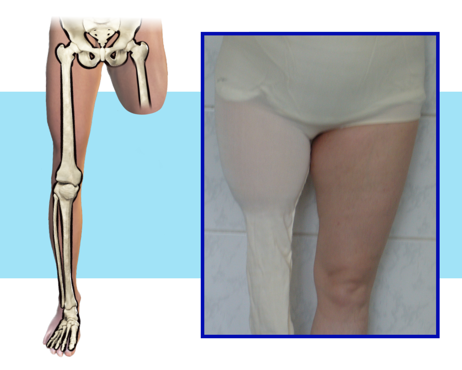Schemat i zdjęcie kończyn dolnych pacjenta ze średnim kikutem uda.
