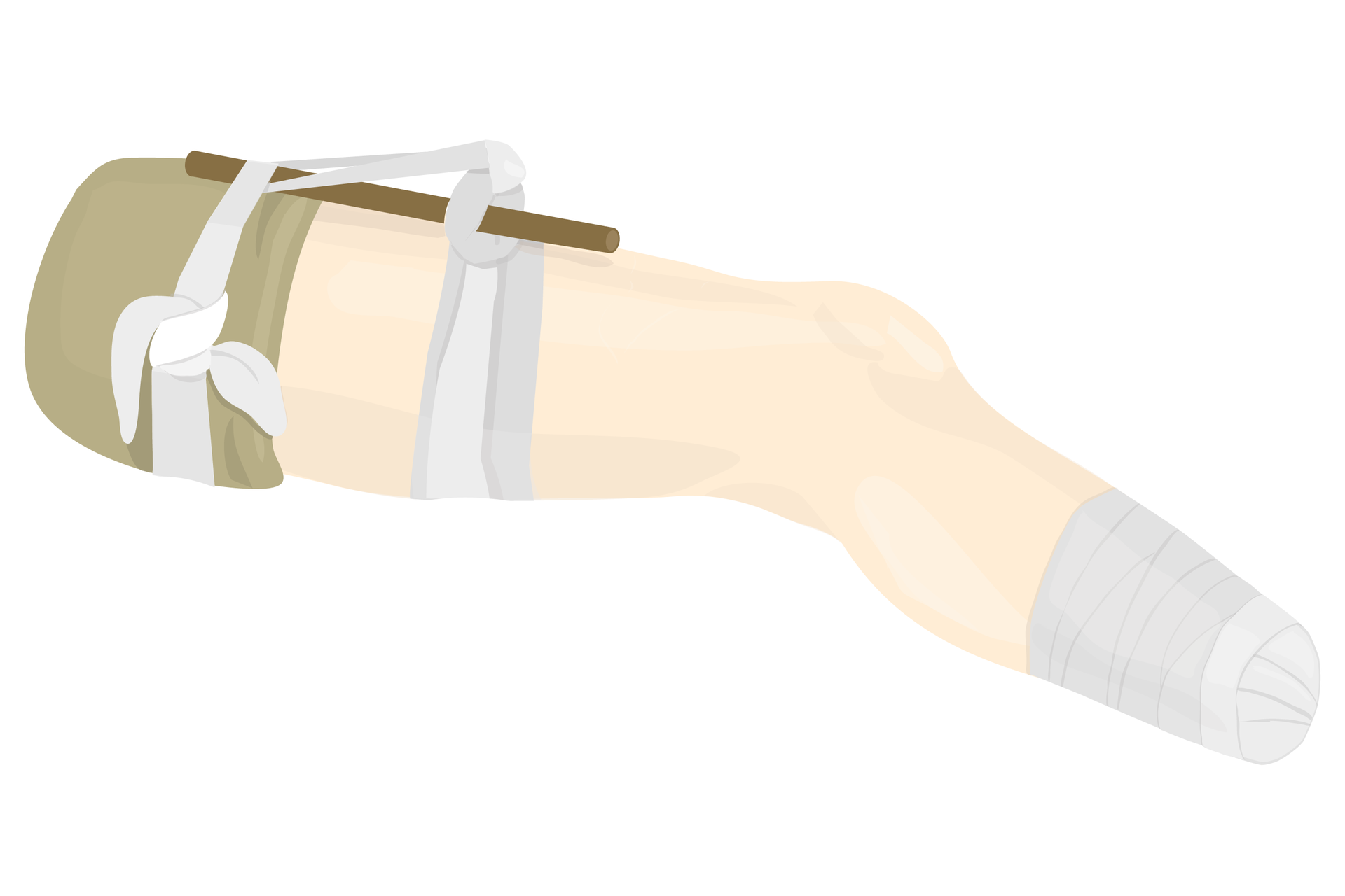 Ilustracja przedstawia sposób stosowania opaski uciskowej na nodze, po amputacji stopy powyżej kostki. Noga poszkodowanego bokiem do obserwatora. Noga zwrócona kolanem w prawą stronę. Wokół uda dwie opaski uciskowe. Opaski wykonane z bandażu. Opaska po lewej na wysokości pachwiny, opaska po prawej w połowie uda. Krótki kij wetknięty jest pod lewą opaskę i przeciągnięty przez węzeł prawej opaski uciskowej. Miejsce po amputacji, poniżej kolana, jest obwiązane bandażem.