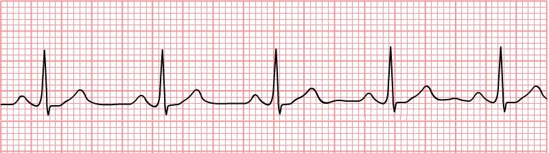 Zdjęcie przedstawia elektrokardiogram w formie krzywej elektrokardiograficznej na specjalnym papierze milimetrowym. Krzywa ma odchylenia w regularnych odstępach.
