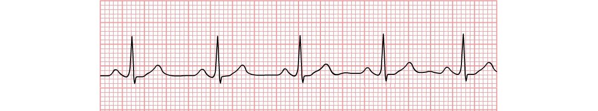 Na ilustracji przedstawiono wykres rytmu serca na papierze milimetrowym.