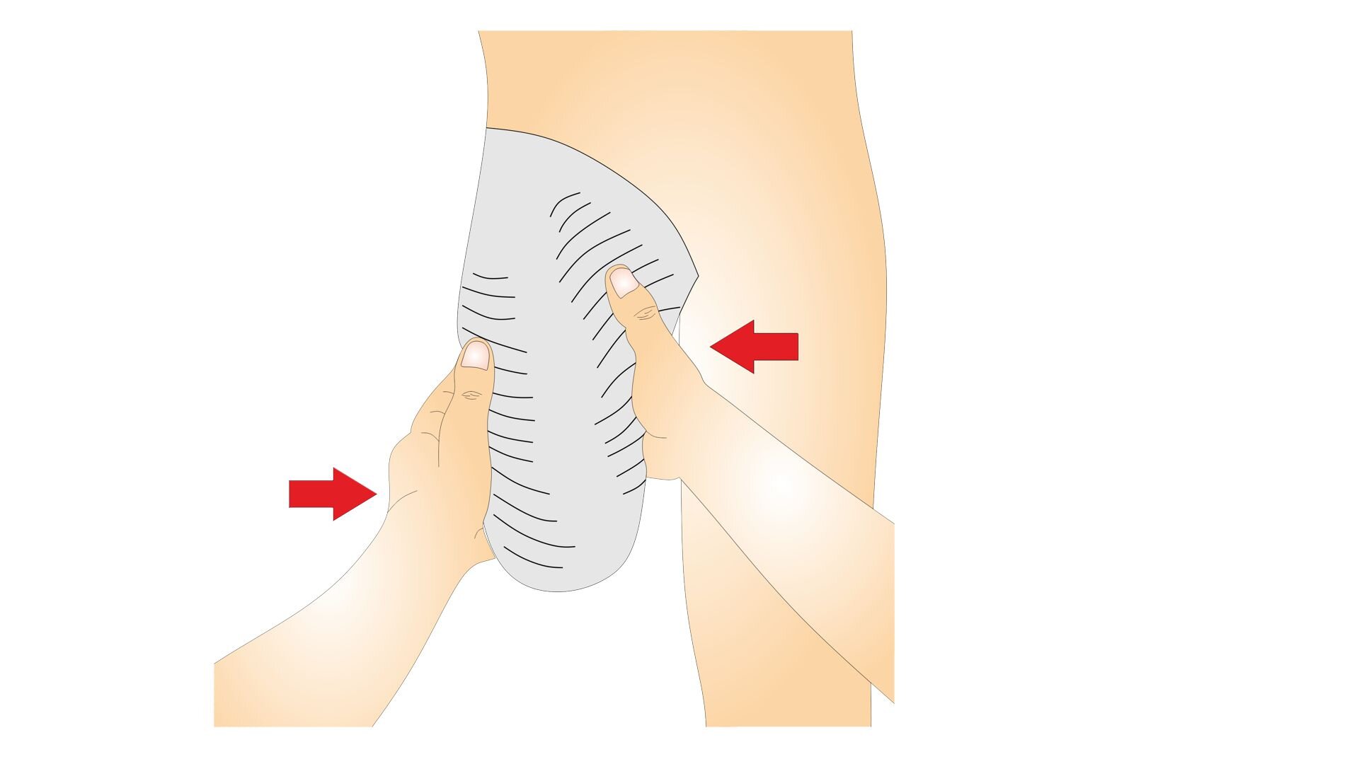 Rycina przedstawia budowę człowieka od przodu, od pasa do stawu kolanowego. Prawa kończyna została amputowana na wysokości stawu kolanowego. Kikut owinięty jest opaską gipsową. Na grafice widnieją strzałki wskazujące miejsca formowania opasek. Jedna z dłoni osoby opatrującej kikut znajduje się pod kroczem pacjenta, a druga – na zewnętrznej części jego uda.
