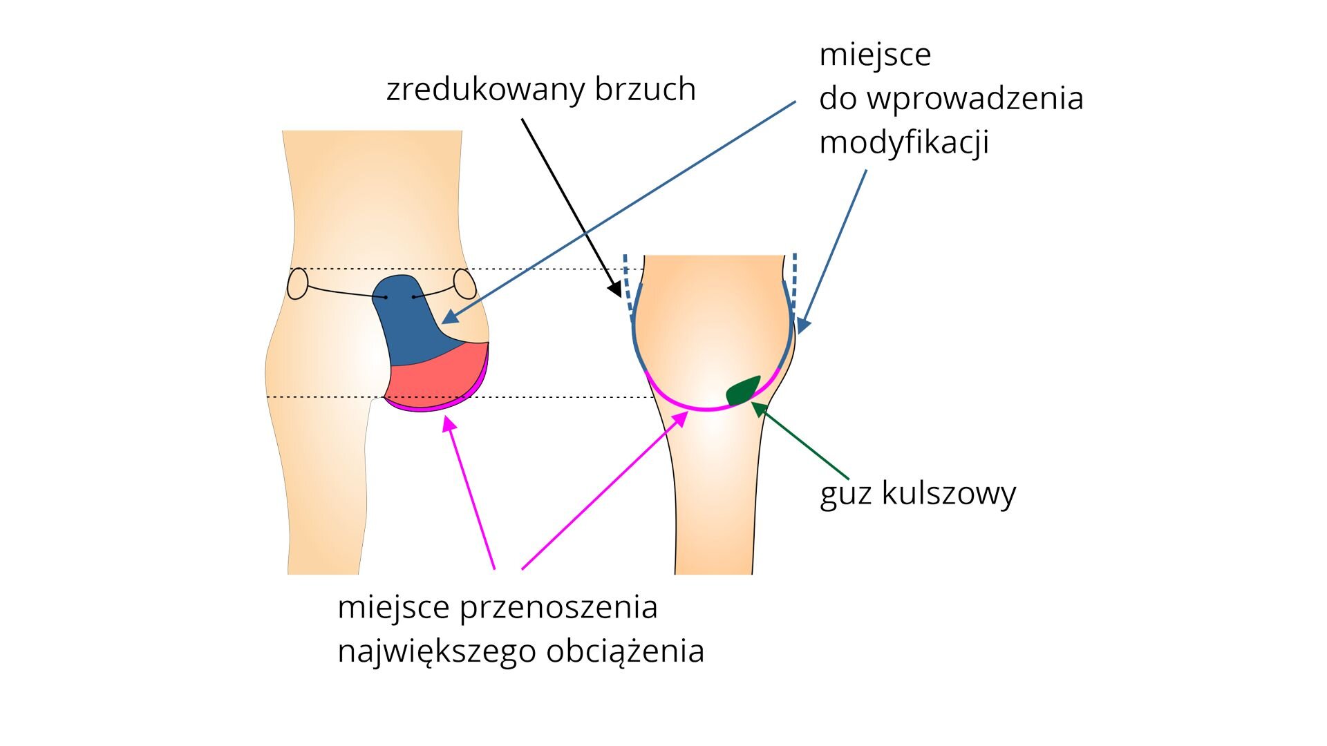 Rycina przedstawia schemat miejsc modyfikacji w metodzie bikini. Miejsce przenoszenia największego obciążenia znajduje się na końcu kikuta. Miejsca do wprowadzenia modyfikacji znajdują się z przodu i z tyłu, po przyśrodkowej stronie kończyny. 
