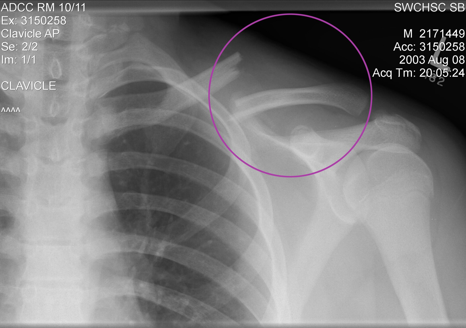 Ilustracja przedstawia rentgenogram, na którym widoczne jest złamanie pewnej kości z powstaniem odłamów kostnych. Jest to długa kość, która stanowi połączenie kończyny górnej ze szkieletem osiowym.