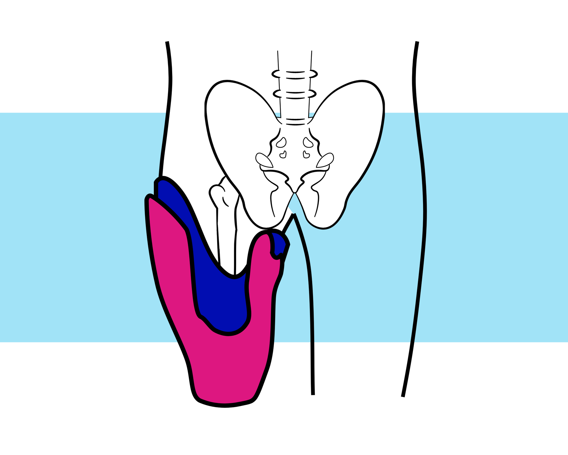 Grafika przedstawia schemat kończyn dolnych wraz ze szkieletem. Jedna z kończyn to kikut. Na rycinie zaznaczono również położenie leja obejmującego kikut. Lej ma podłużne, centralne wycięcia na tylnej ścianie.