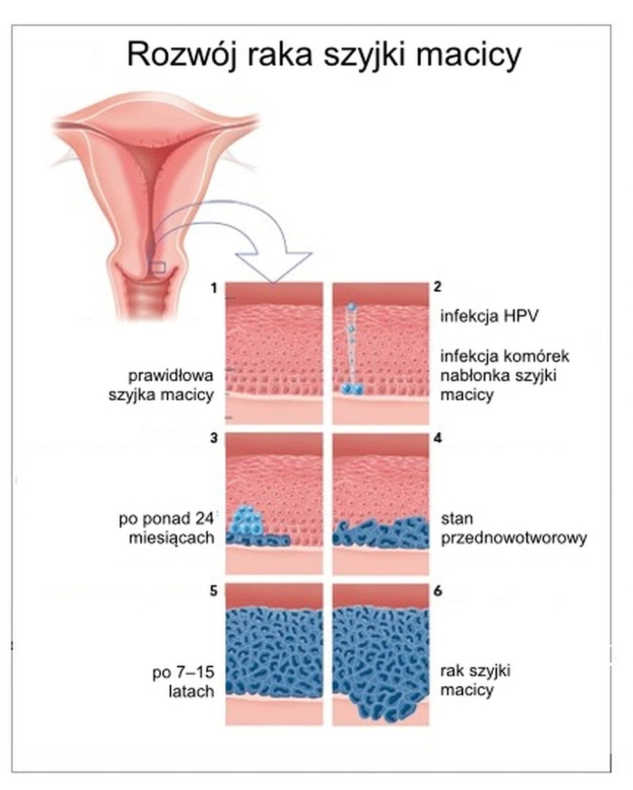 Grafika przedstawia etapy rozwoju raka szyjki macicy. U góry tytuł: Rozwój raka szyjki macicy. Poniżej widać macicę, która ma kształt odwróconego trójkąta, czyli zwęża się ku dołowi. Na dole jest wejście do macicy, znajduje się tam szyjka macicy. Fragment szyjki zaznaczony jest prostokątem. Od prostokąta do obrazka obok prowadzi strzałka. Obrazki obok ukazują sześć kolejnych etapów rozwoju raka szyjki macicy. Obrazek pierwszy prawidłowa szyjka macicy. Widać rzędy różowych komórek o okrągłych jądrach. Obrazek drugi infekcja HPV. Infekcja komórek nabłonka raka szyjki macicy. Na różowym nabłonku szyjki pojawiają się niebieskie komórki. Obrazek trzeci po ponad dwudziestu czterech miesiącach. Niebieskie komórki nowotworowe namnożyły się, widać ich więcej niż na poprzednim obrazku. Mają one nadal kształt zdrowych komórek. Obrazek czwarty stan przednowotworowy. Na rysunku widać liczne niebieskie komórki nowotworowe. Mają one nieregularny kształt i różnej wielkości i kształtu jądra komórkowe. Obrazek piąty po siedmiu do piętnastu latach. Na obrazku nie widać zdrowych różowych komórek. Komórki nowotworowe tworzą wiele warstw. Komórki mają nieregularne kształty i różnej wielkości i kształtu jądra. Obrazek szósty rak szyjki macicy. Komórki nowotworowe zaczynają naciekać poza pierwotną tkankę, guz powiększa się.