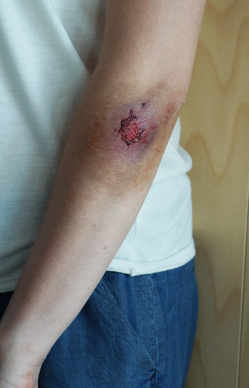 Zdjęcie przedstawia ranę tłuczoną. Zbliżenie na lewą rękę osoby poszkodowanej. Na łokciu i powyżej niego zdarty naskórek. Wokół rany sine zabarwienie skóry.