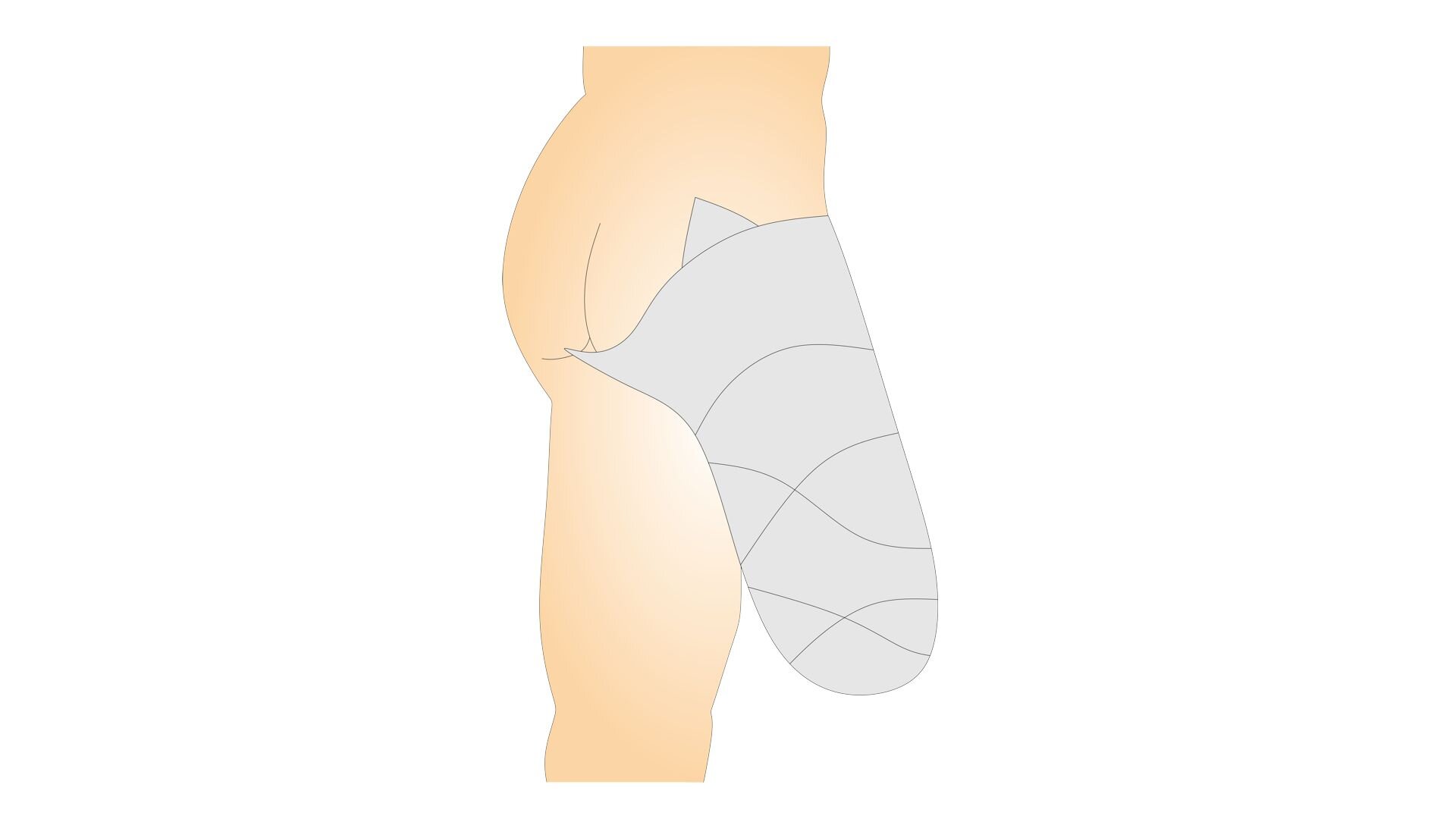 Rycina przedstawia budowę człowieka od tyłu, od pasa do stawu kolanowego. Prawa kończyna została amputowana na wysokości stawu kolanowego. Powierzchnia całego kikuta jest owinięta opaską gipsową. 