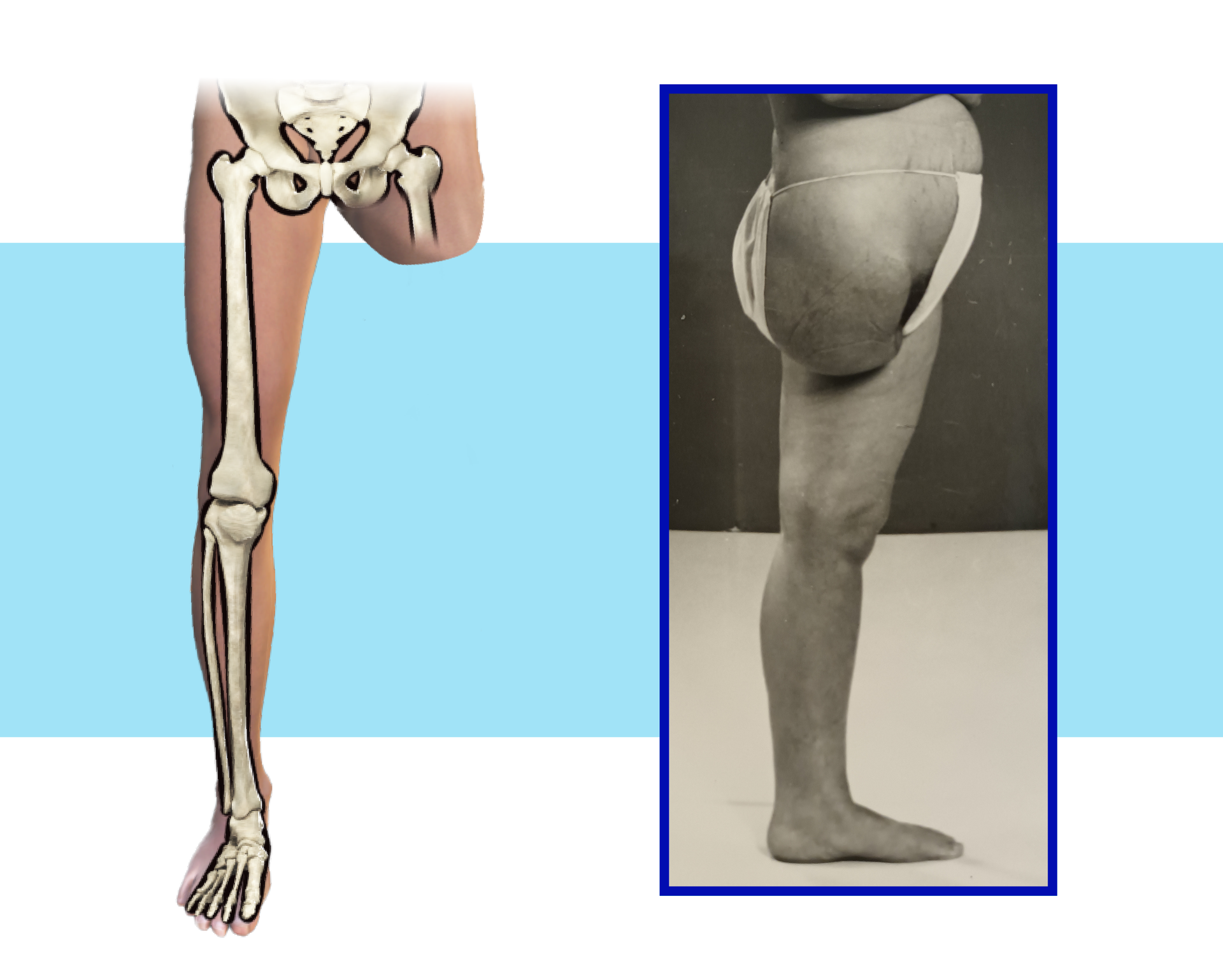Schemat i zdjęcie kończyn dolnych pacjenta z krótkim kikutem uda.
