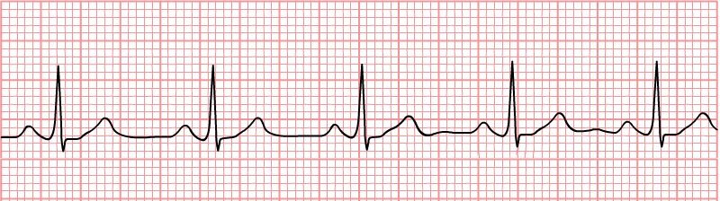 Grafika przedstawia zapis EKG. Jest on prawidłowy. W regularnych odstępach wykres unosi się oraz opada.   