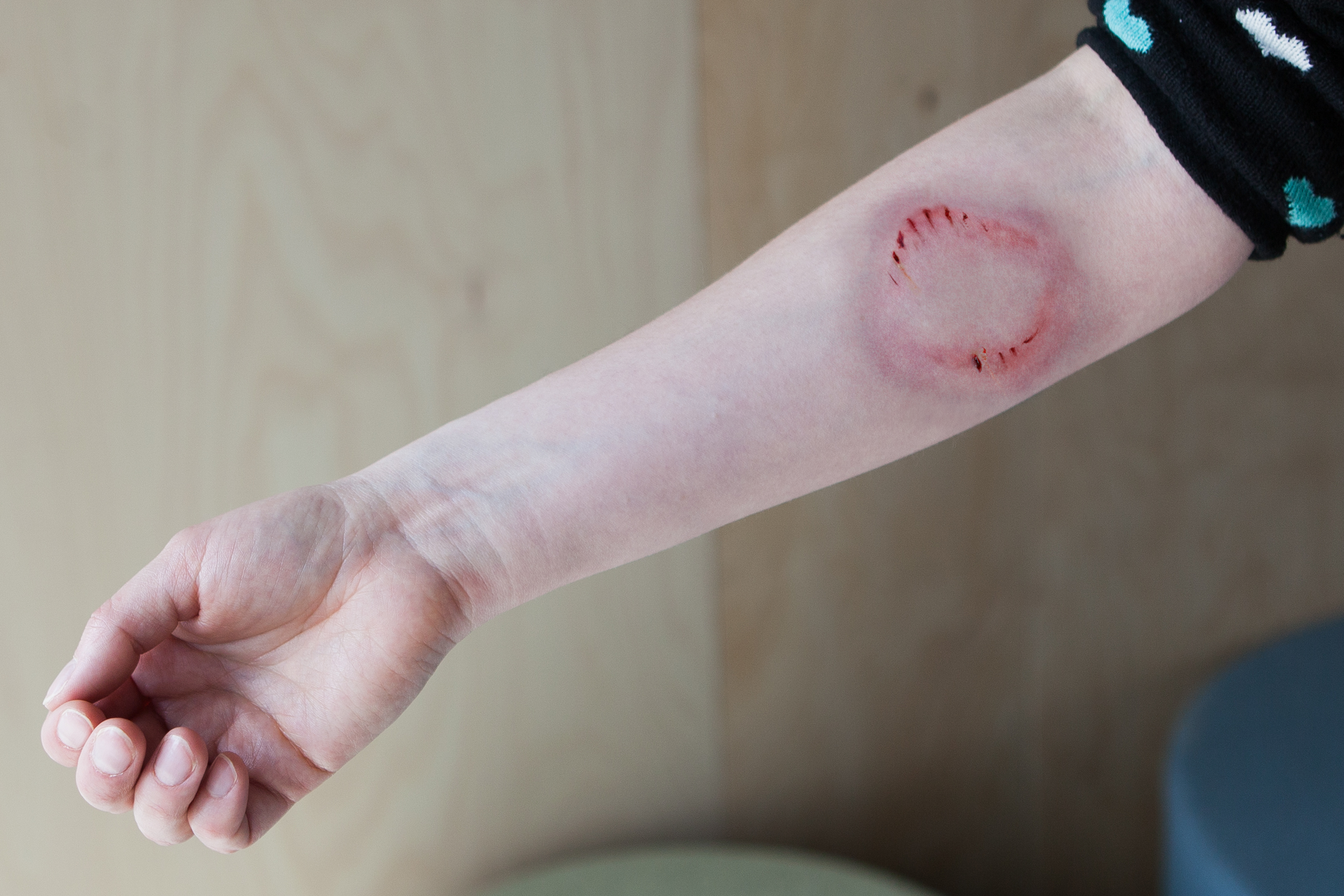 Zdjęcie przedstawia ranę kąsaną. Zbliżenie na prawe przedramię. Poniżej łokcia znajduje się okrąg utworzony z czerwonych ranek stanowiących ślady ostrych zębów otwartej szczęki. Dookoła wyraźne zsinienie skóry.