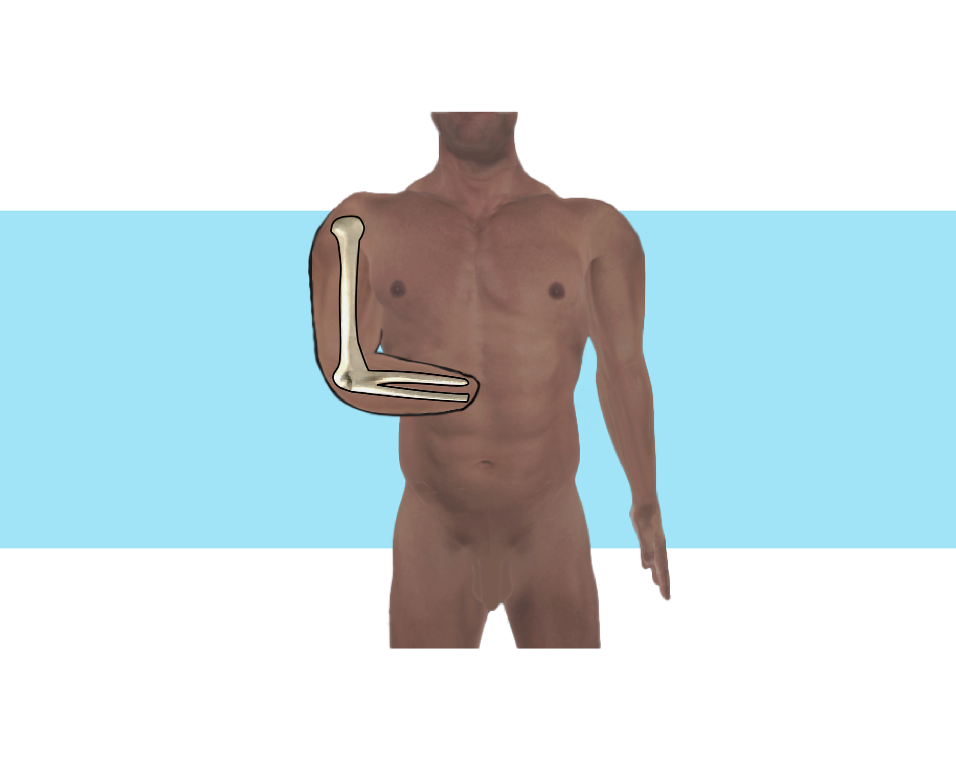 Grafika przedstawia człowieka z długim kikutem przedramienia. Na kikucie zaznaczono struktury kostne ramienia i przedramienia. 