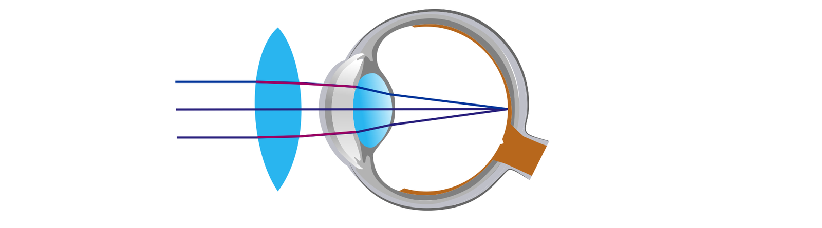 Na ilustracji zostało schematycznie pokazane oko jako kula. Przed okiem widzimy soczewkę skupiającą. Przed soczewką biegną równoległe do siebie promienie światła w postaci odcinków. W momencie przejścia przez soczewkę ulegają one załamaniu i skupiają się nieznacznie, następnie przechodzą przez soczewkę oka i przecinają się w jednym punkcie znajdującym się na siatkówce oka. W ten sposób korygujemy wadę wzroku zwaną krótkowzrocznością.